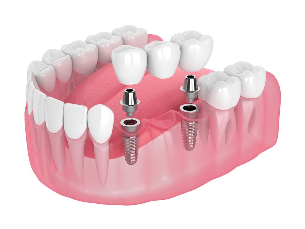 implante dentário em altamira